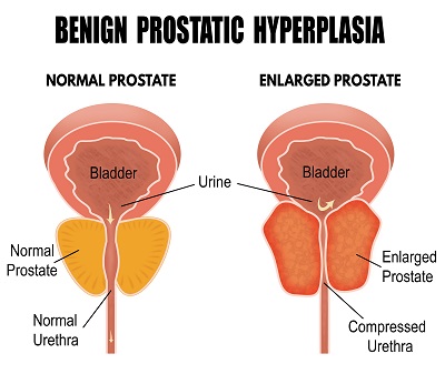 Enlarged Prostate